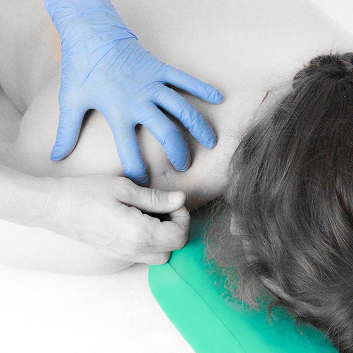 <i>Dry Needling</i> muscle supra-épineux